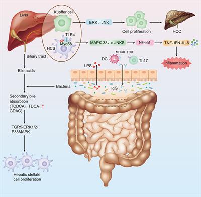 Intestinal flora plays a role in the progression of hepatitis-cirrhosis-liver cancer